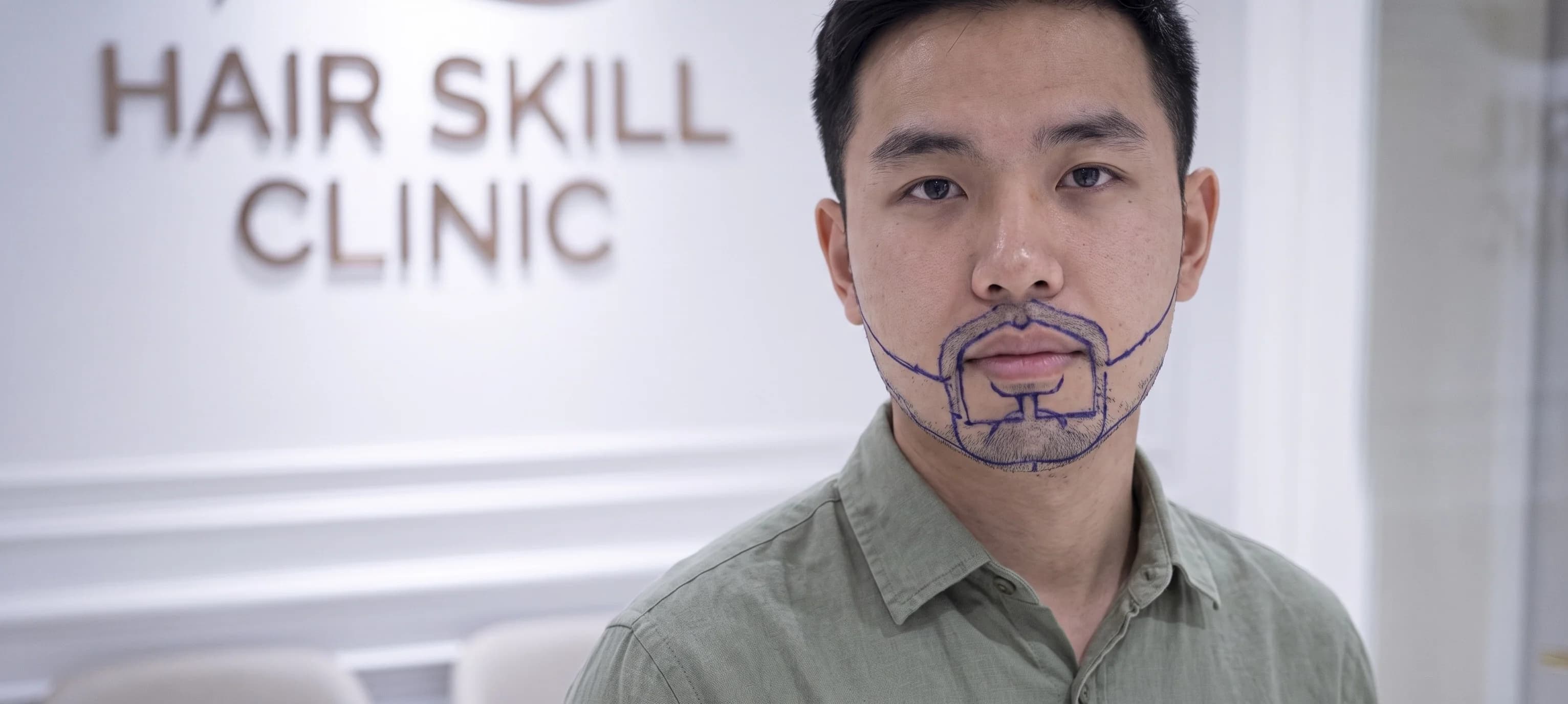 Patient J.V., 24 years old, mapped with black pen marker for 4560 graft lower face procedure