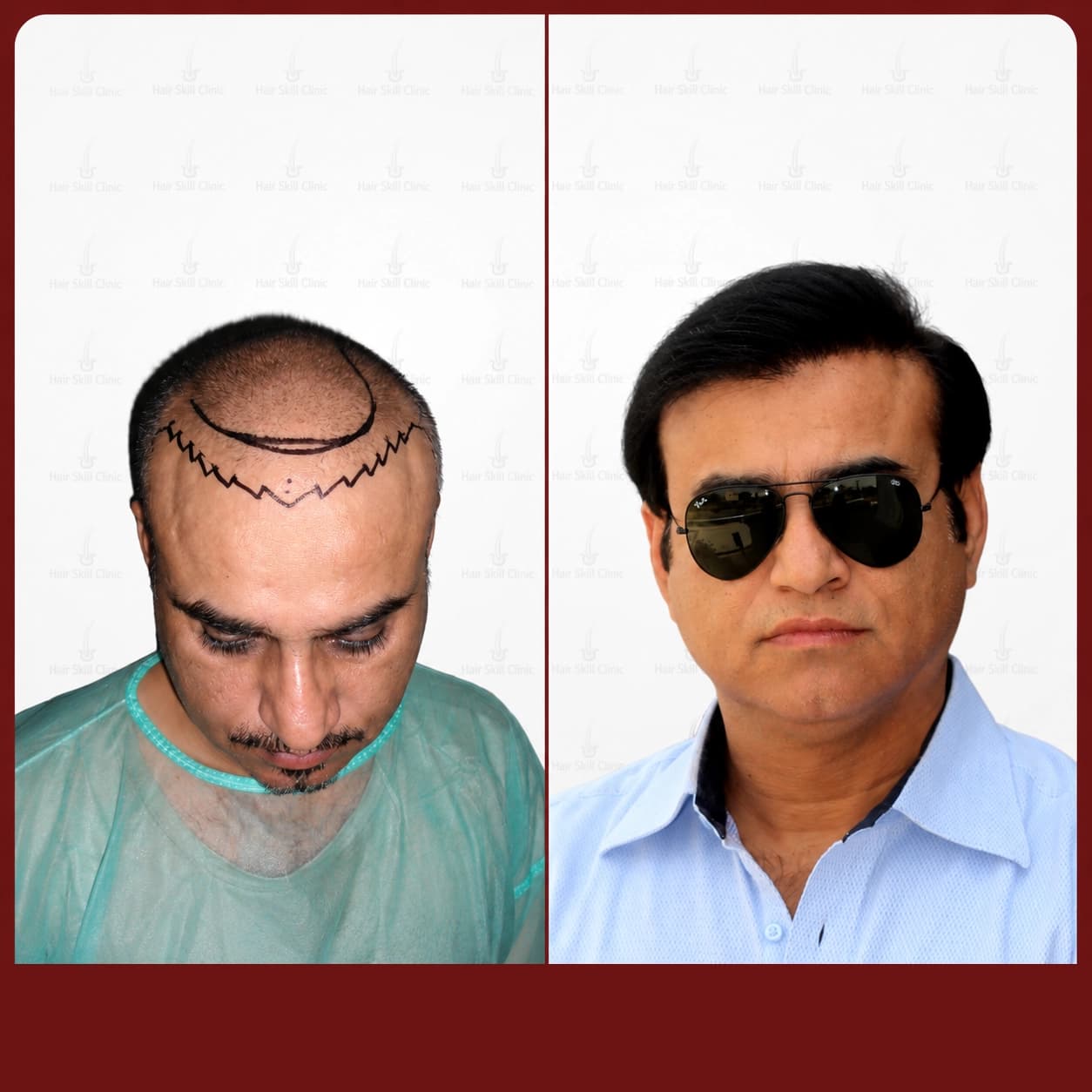 Grafts Transformation Result 13