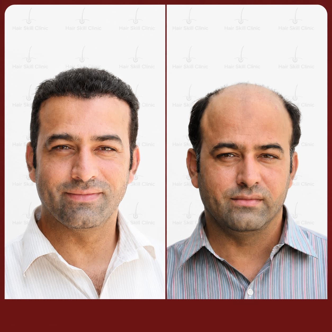 Grafts Transformation Result 23