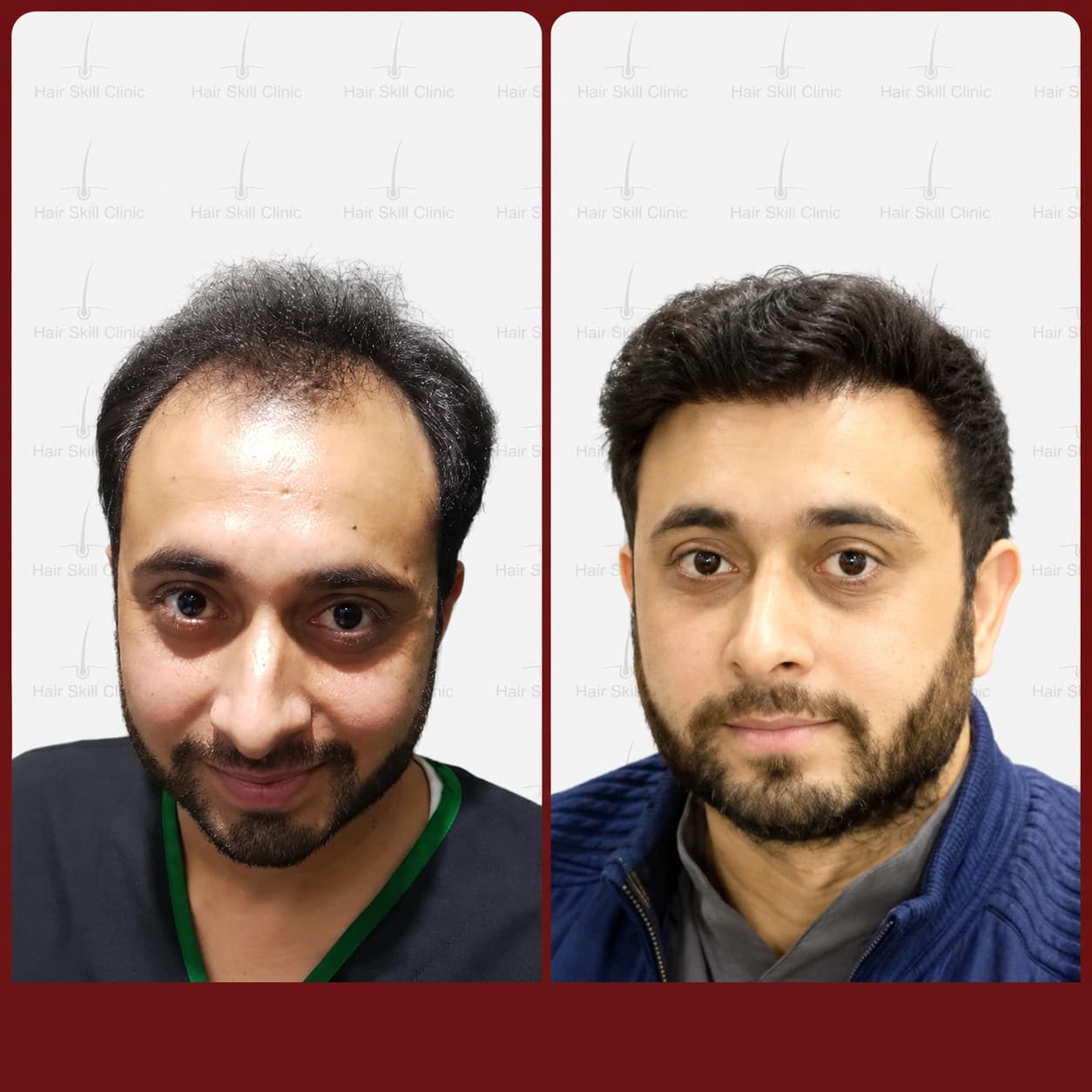 Grafts Transformation Result 29