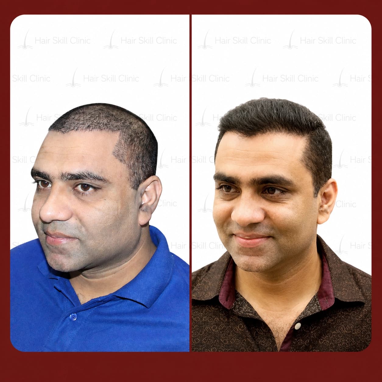 Grafts Transformation Result 1