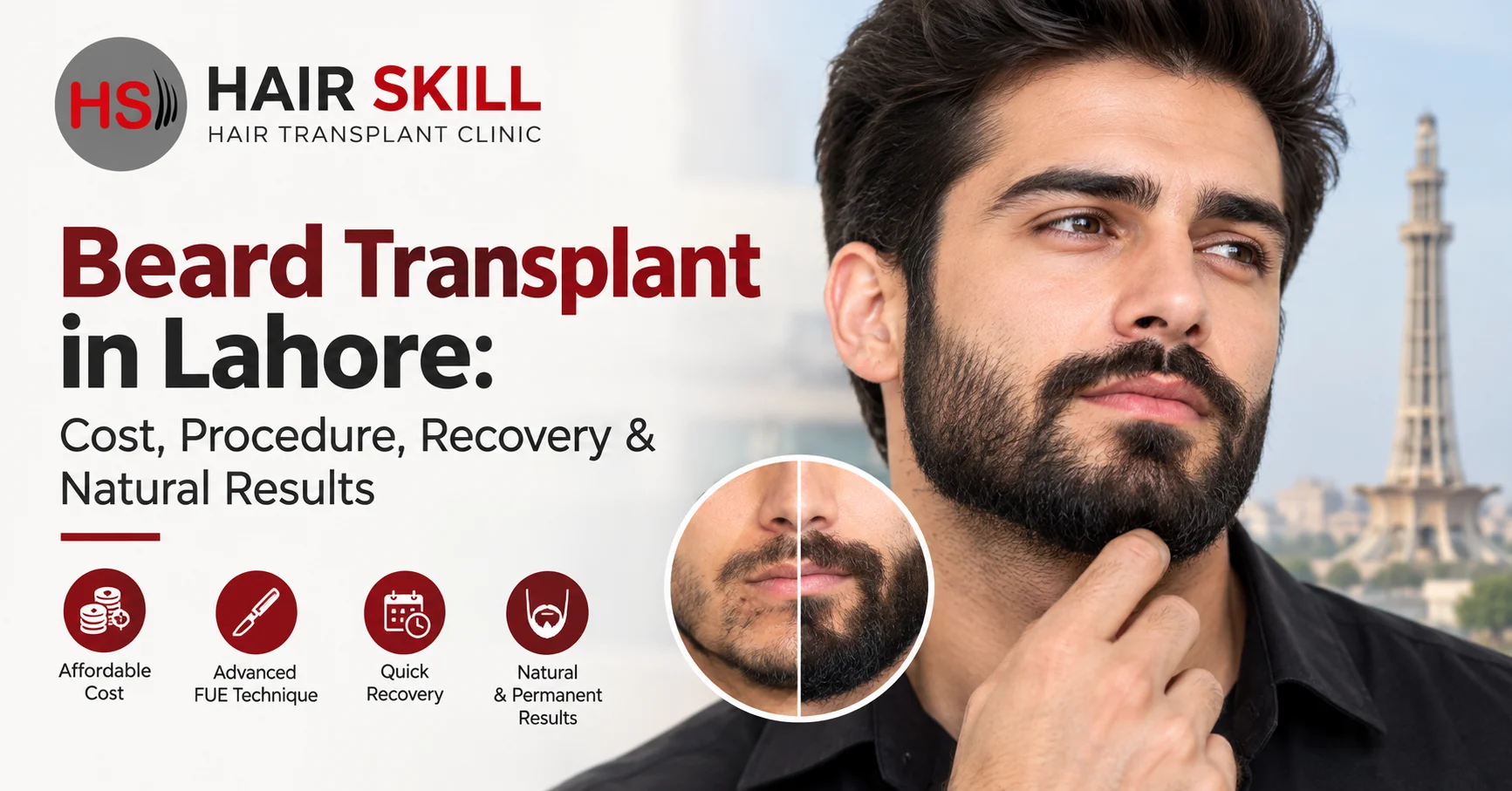 Beard Transplant in Lahore: Cost, Procedure, Recovery & Natural Results