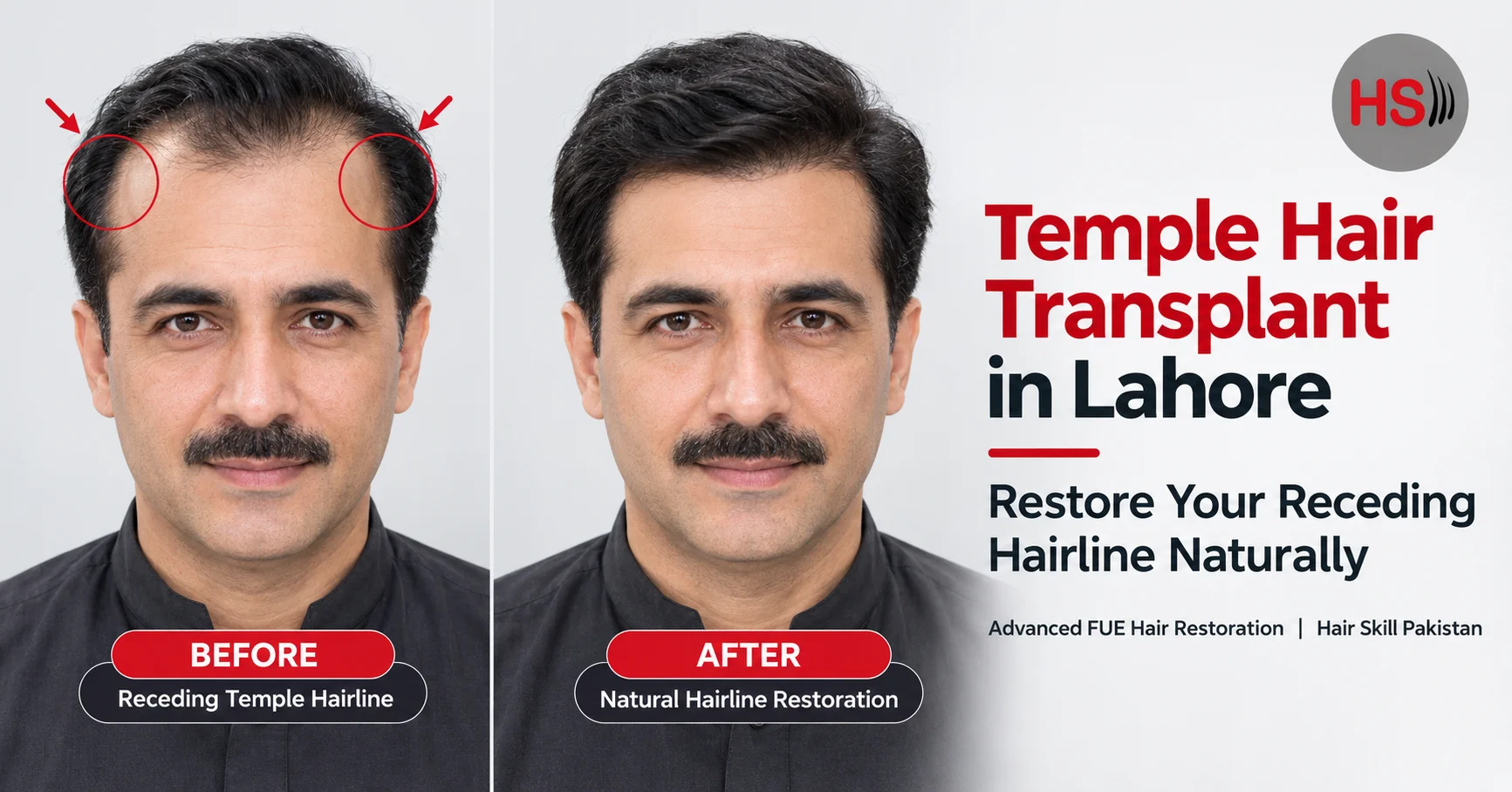 Sideburn Hair Transplant in Lahore: How We Fix Uneven Facial Hair Naturally