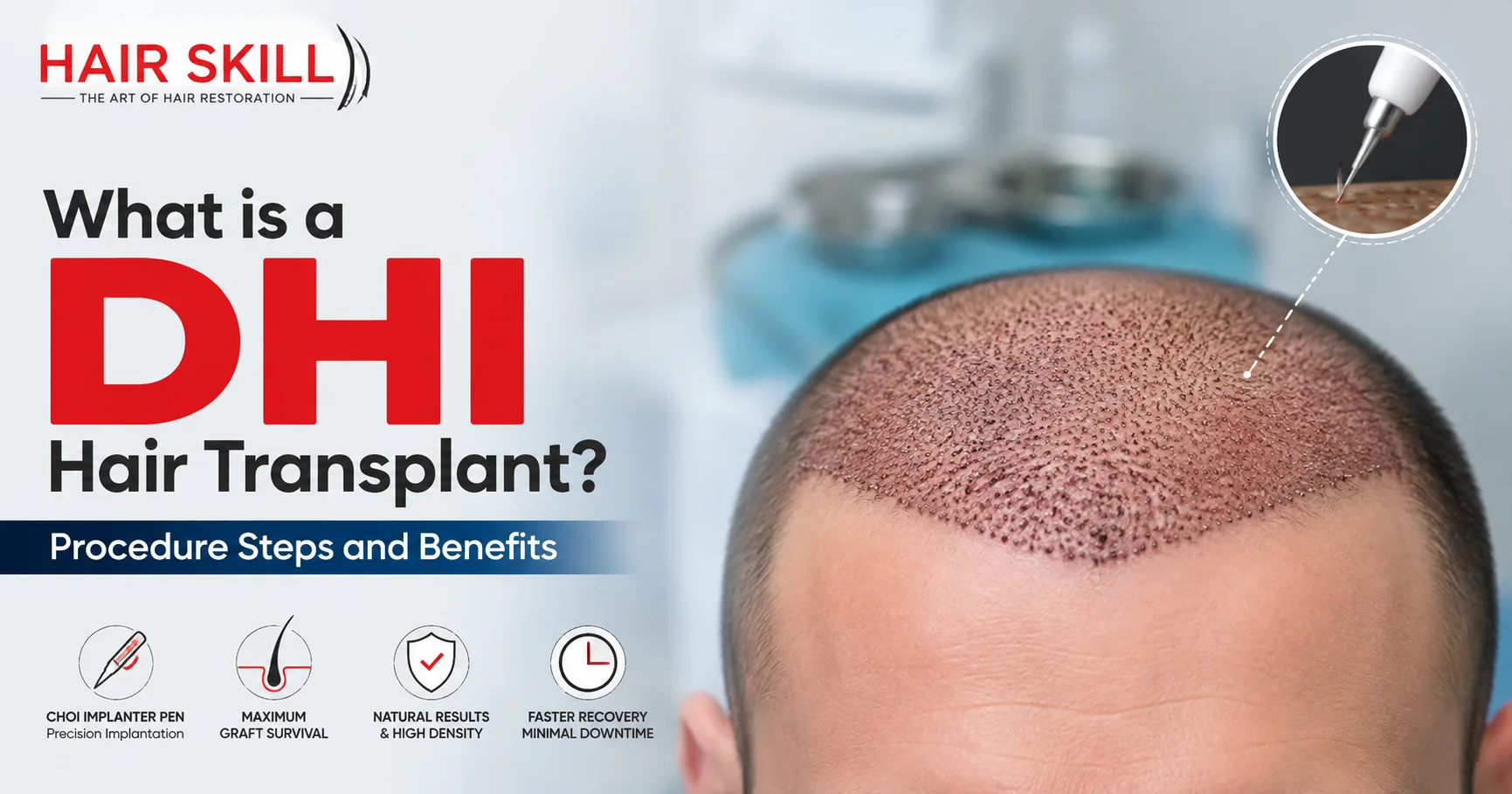 What is a DHI Hair Transplant? Procedure Steps and Benefits