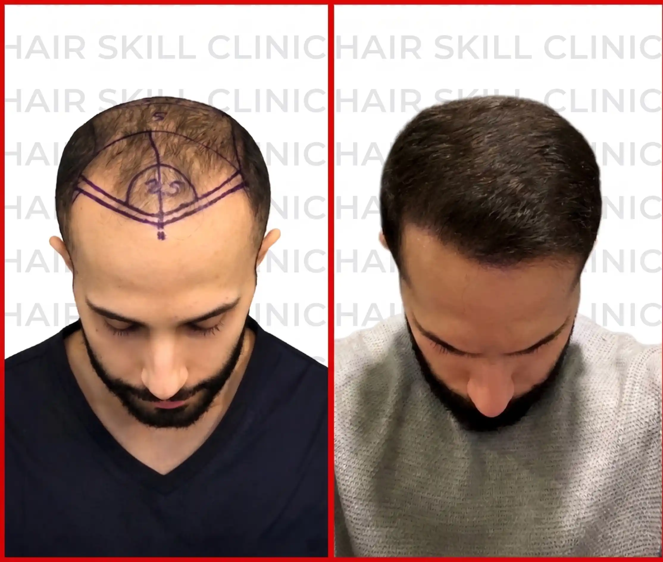 Doctor examining patient scalp density reserves using clinical diagnostic dermatoscope lens