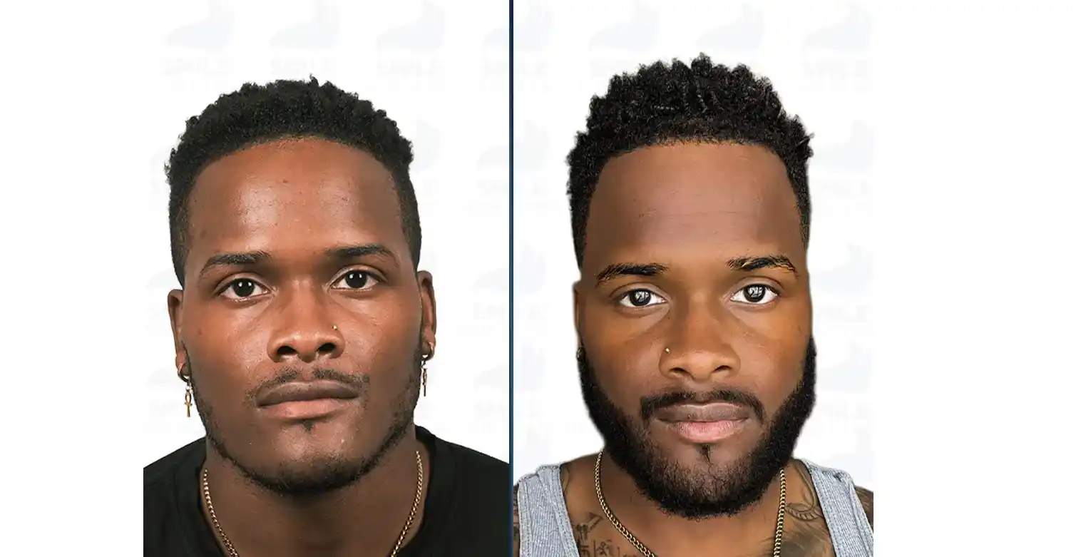 Side by side comparison of Afro patient in yellow shirt showing native frontal thinning versus restored dense mature hairline