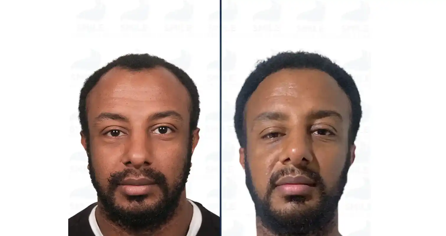 Frontal downward view comparing thinned native Afro hairline profile against dense restored mature results