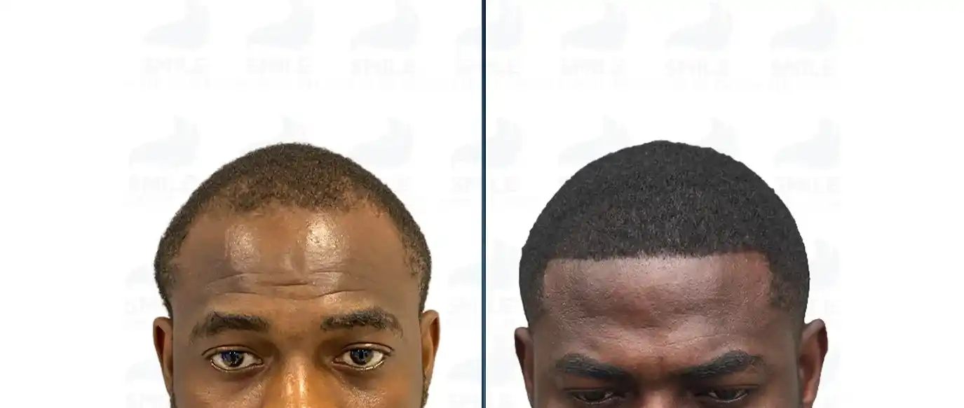 Clinical examination of African American female hairline and edges using diagnostic dermatoscope lens