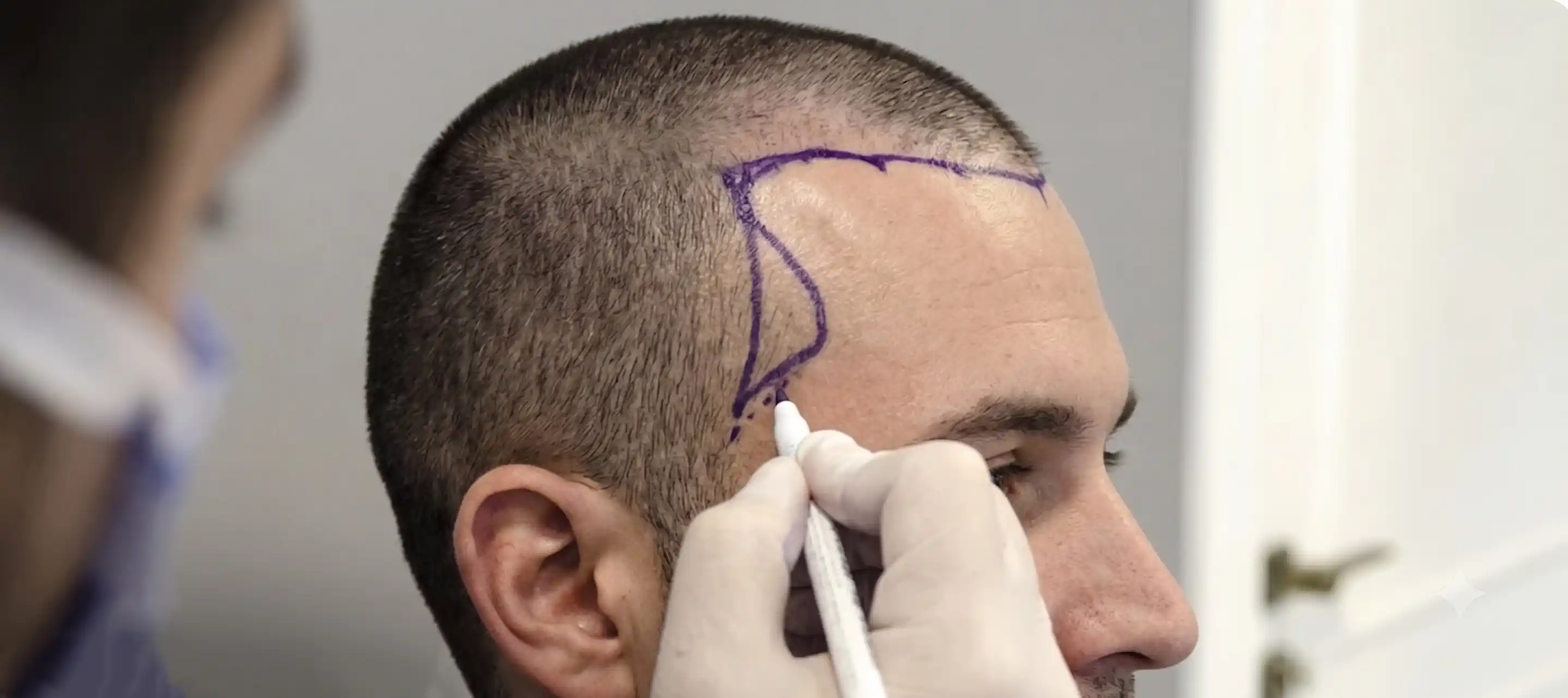 Doctor drawing precise sideburn restoration outline on patient temple before surgical extraction
