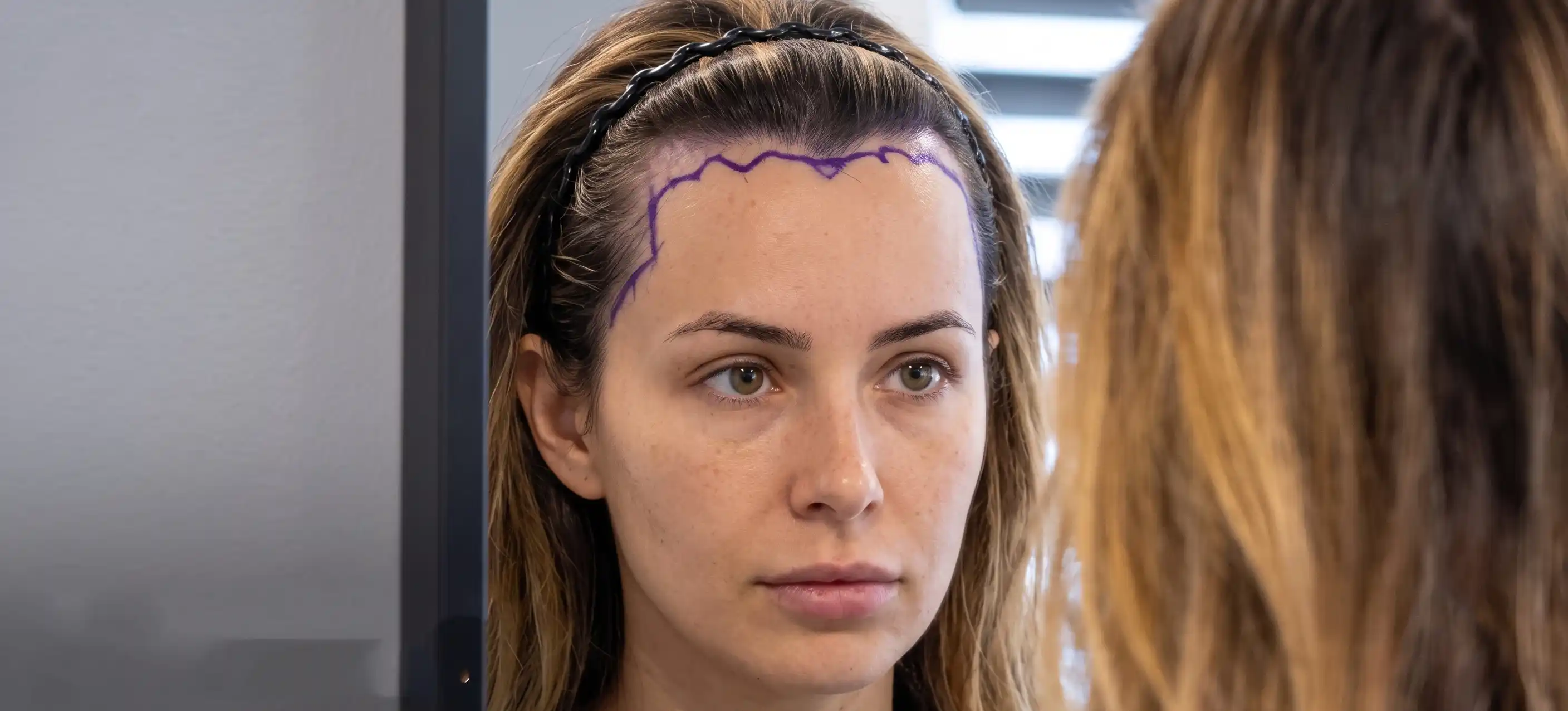 Female patient examining pre surgical hairline markings inside mirror at Hair Skill Clinic