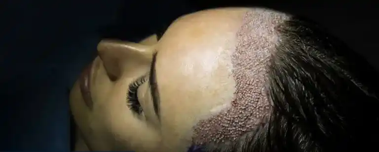 Macro close up view of delicate female part line follicular units K.C., 27 years old, 2400 grafts