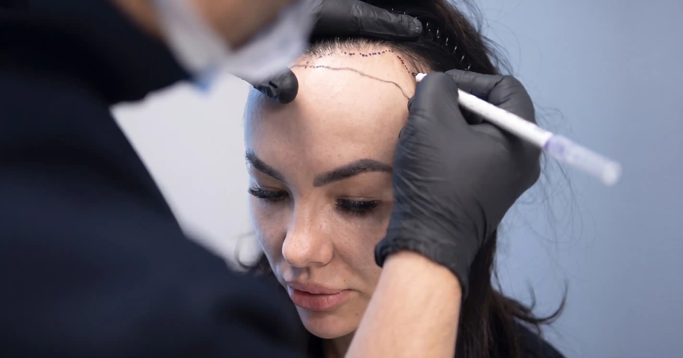 Surgeon drawing delicate lowered feminine hairline contour on patient K.K., 37 years old