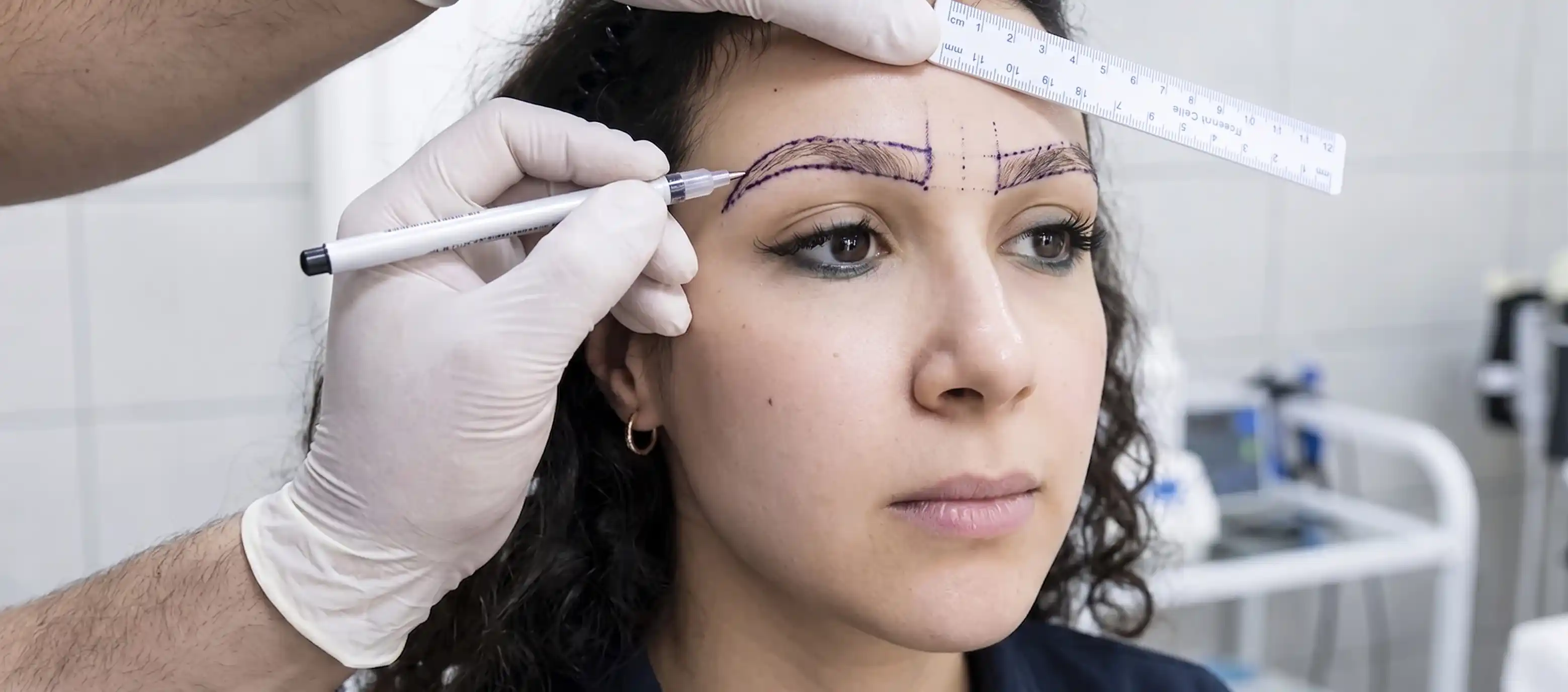 Surgeon placing delicate single hair grafts into female brow S.F.H., 33 years old, 650 grafts
