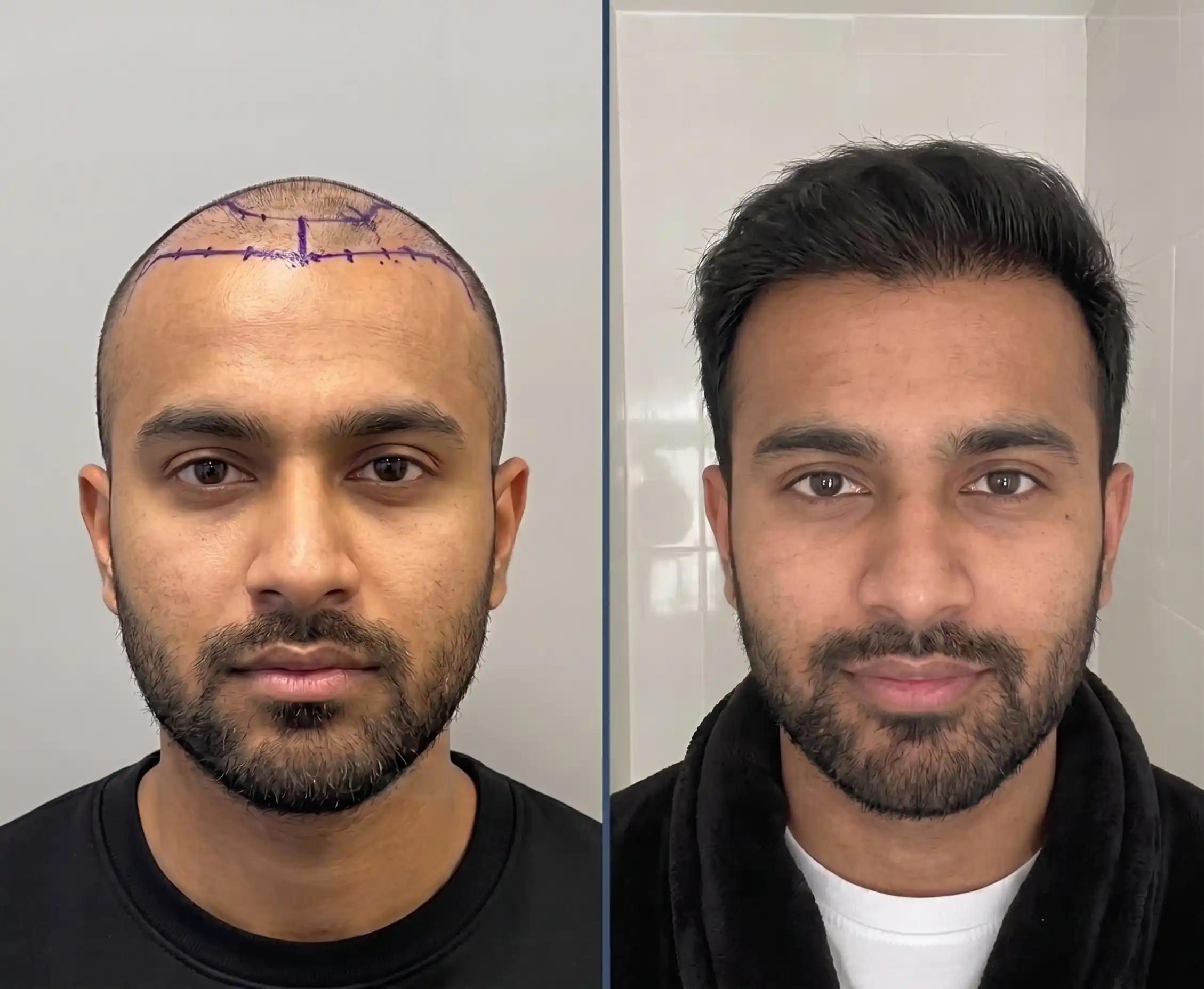 Frontal view comparing lowered pre surgical Sapphire FUE hairline markings against mature dense growth