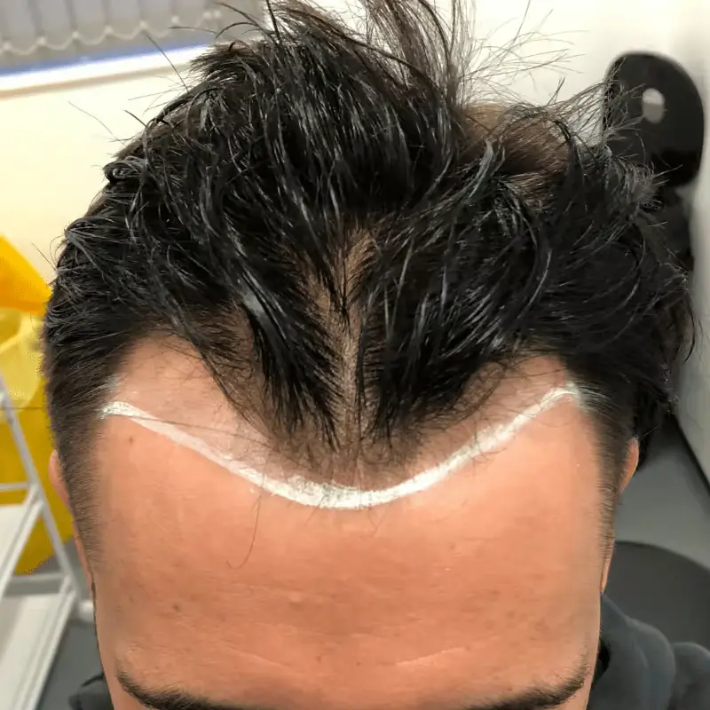 Top surgical view of patient forehead marked with white mapping pencil