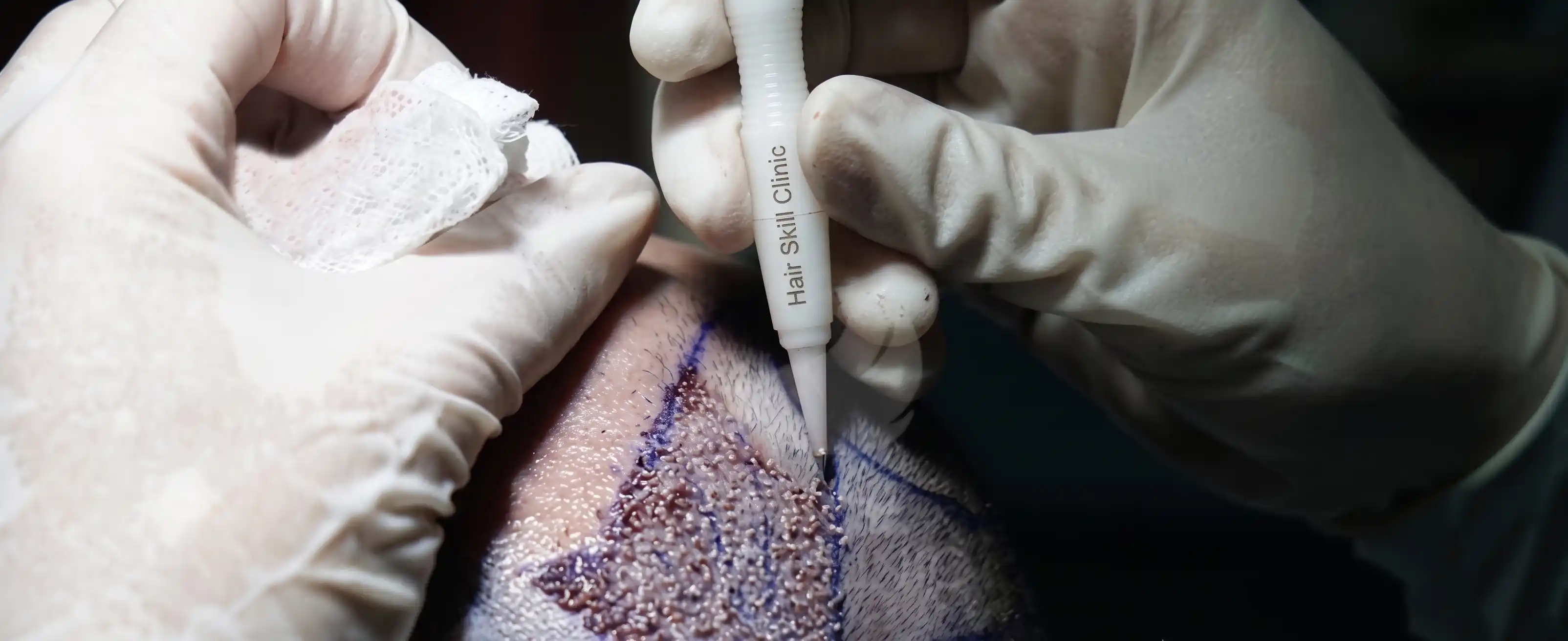 Macro close up view of surgeon executing precise V shaped micro channel incision into scalp