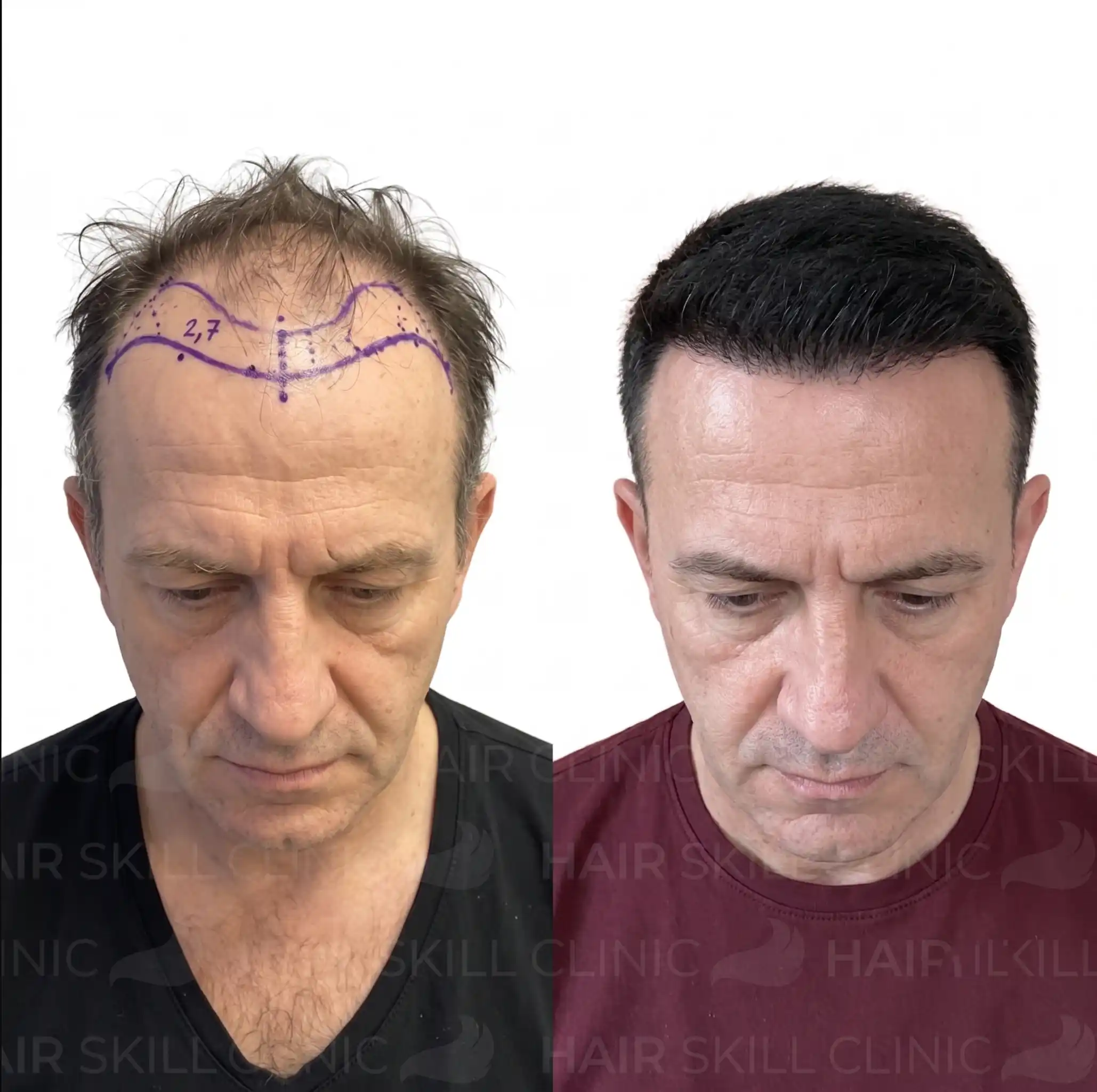 Frontal and oblique diagnostic views of patient forehead mapped for graft volume distribution