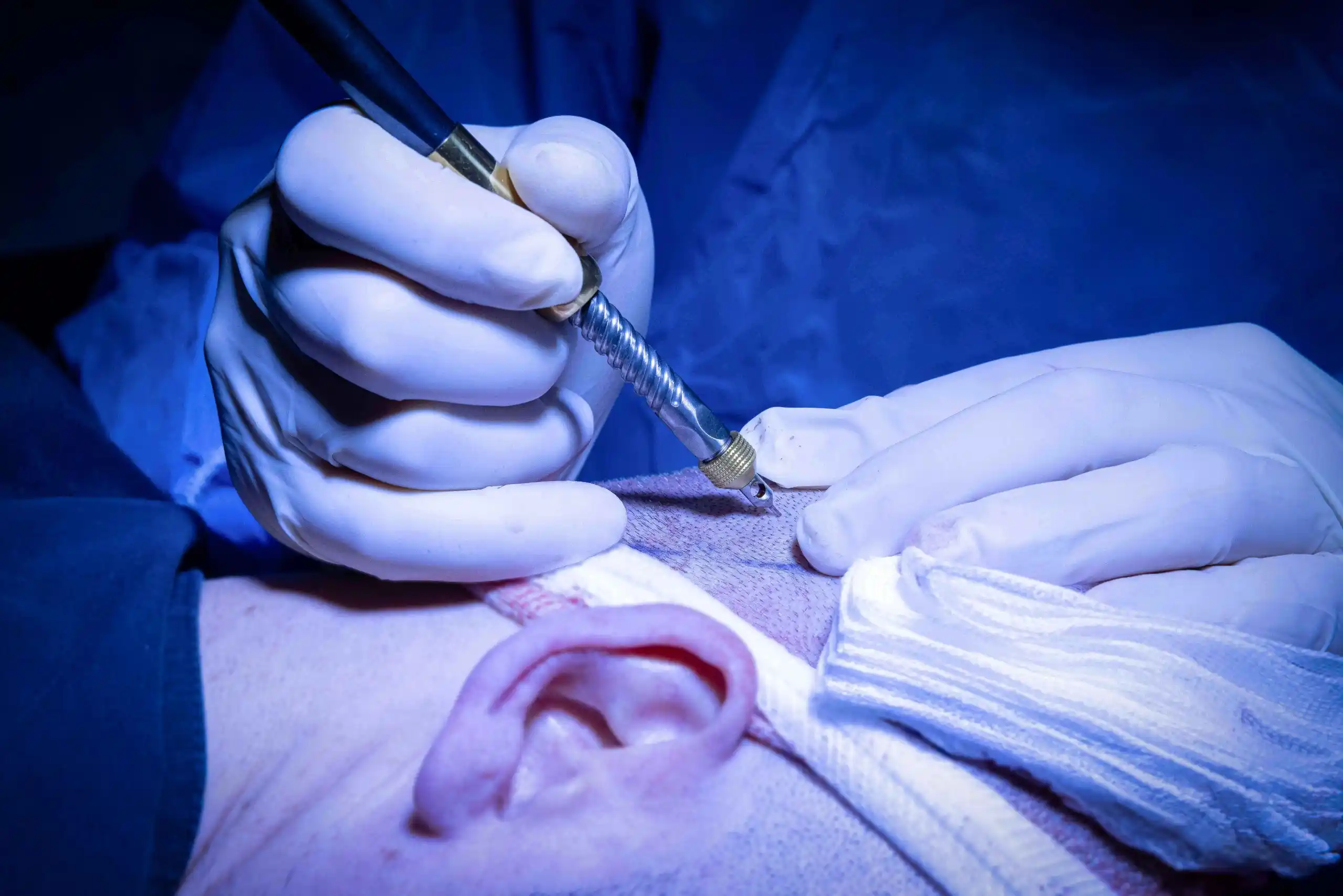 Surgeon performing controlled manual punch extraction at Hair Skill Clinic
