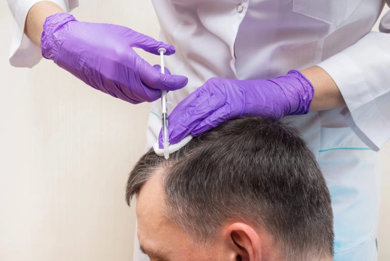 Medical professional wearing sterile purple gloves administering precise PRP cellular injection into patient scalp at Hair Skill Clinic