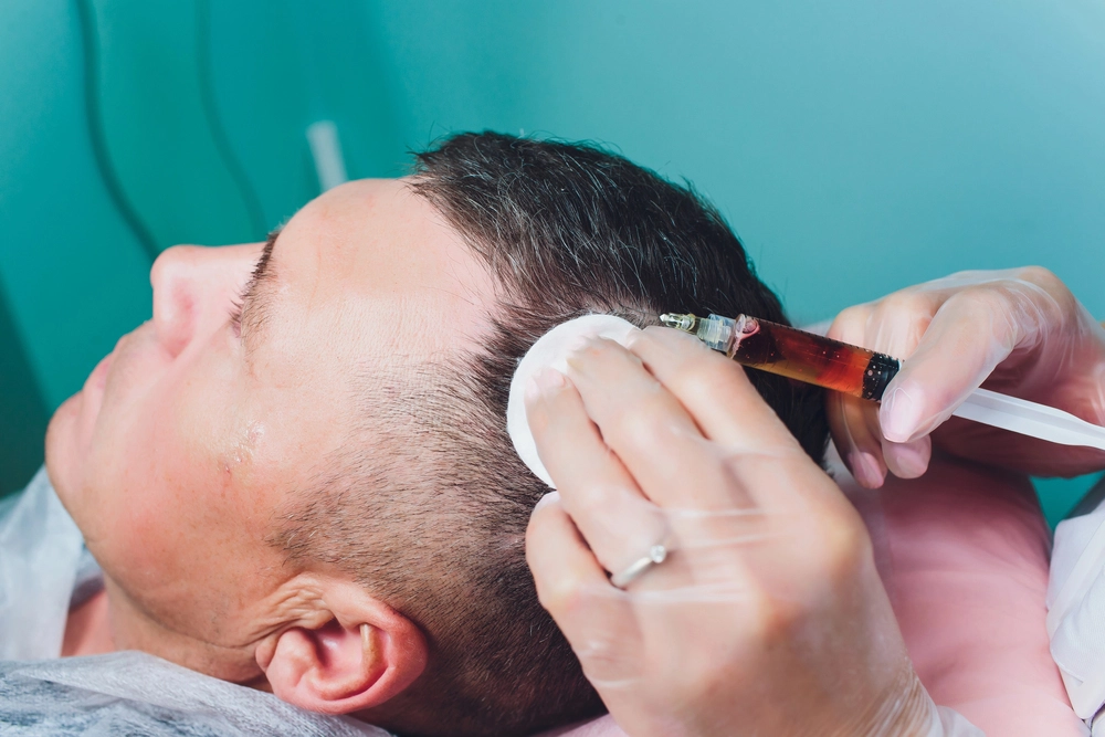 Surgeon administering precise localized platelet plasma dosage into male frontal temple peak at Hair Skill Clinic