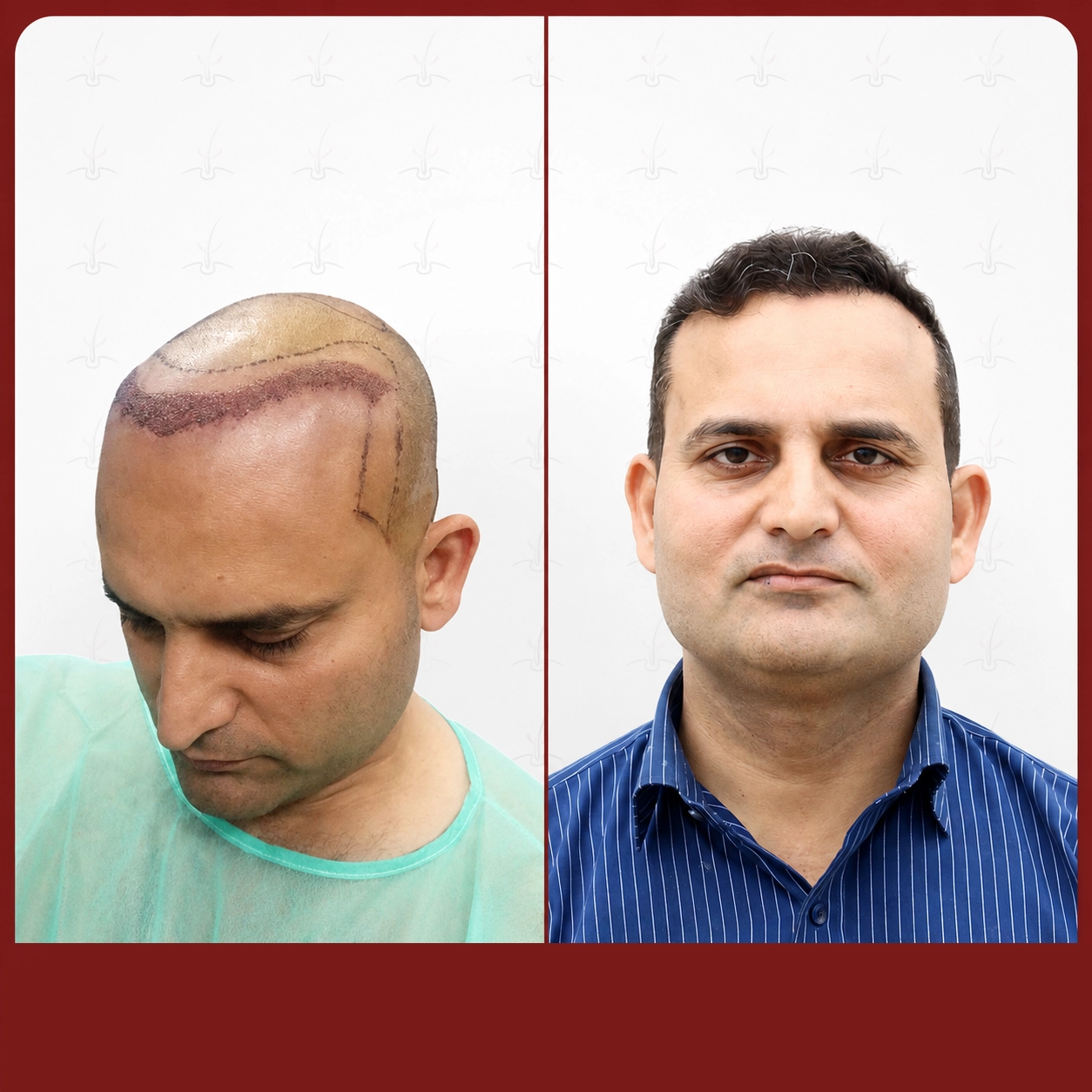 Grafts Transformation
