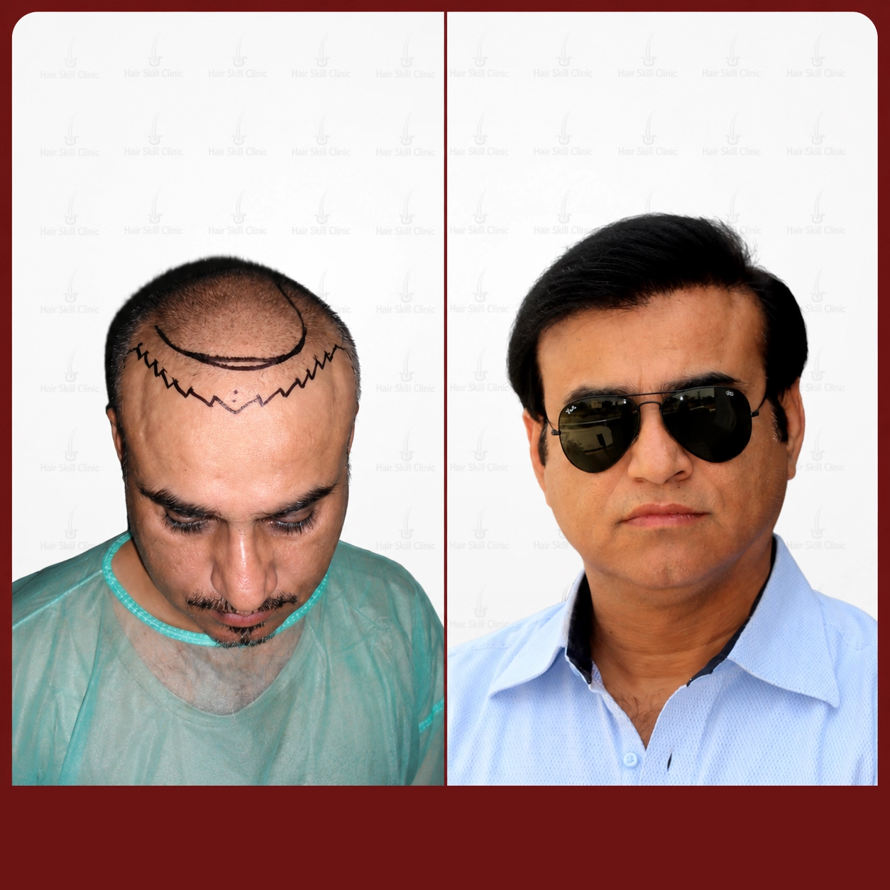 Grafts Transformation