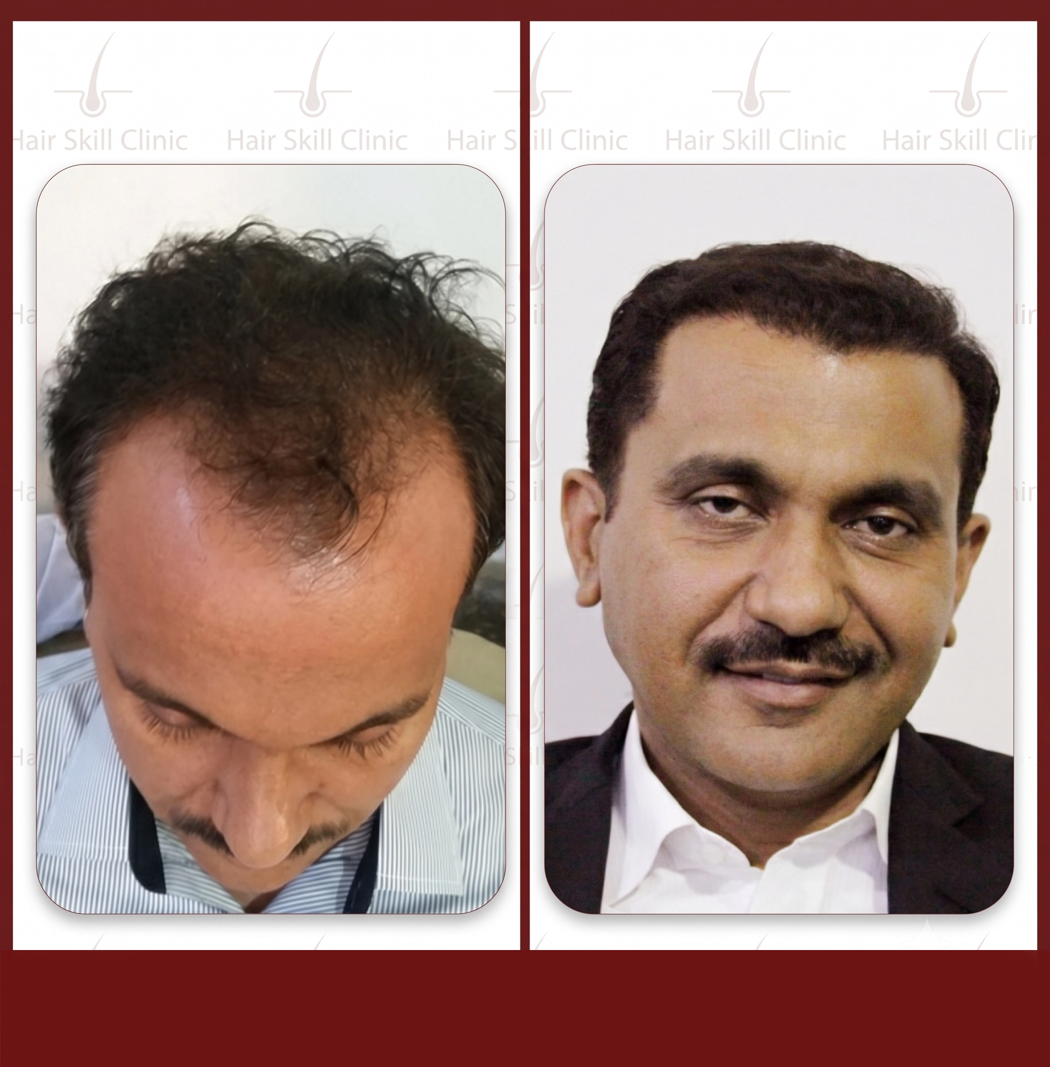 Grafts Transformation