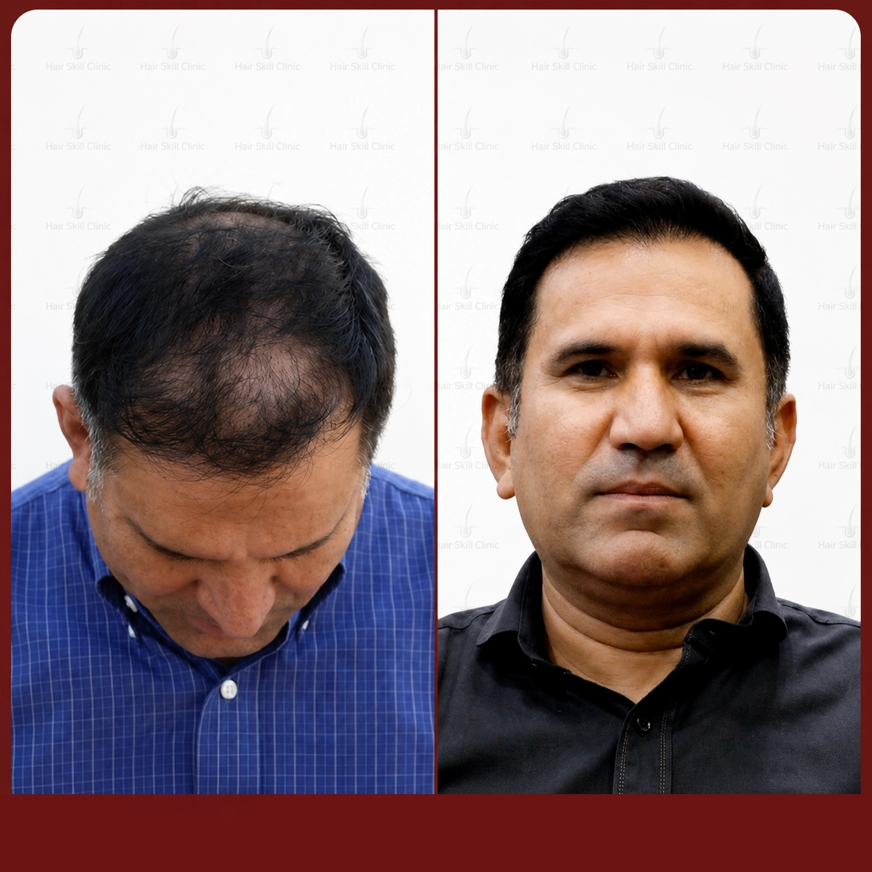 Grafts Transformation