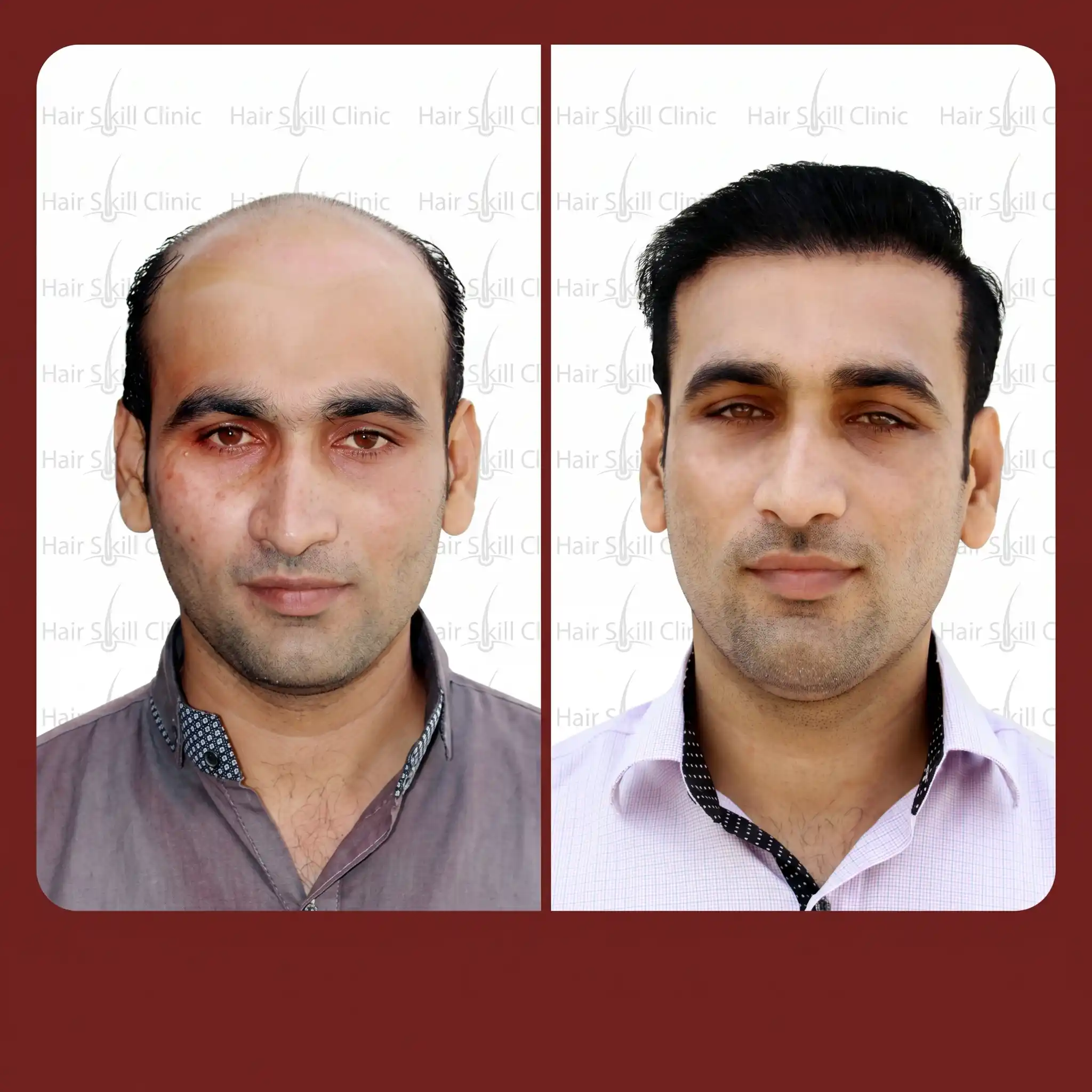 Grafts Transformation