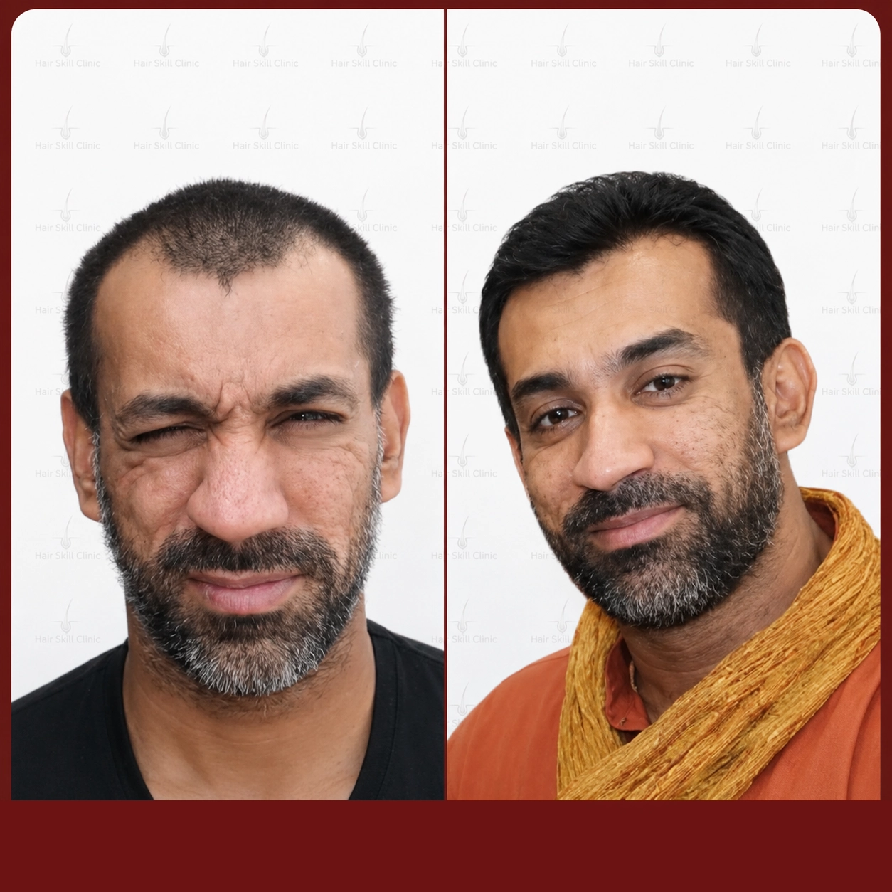 Grafts Transformation