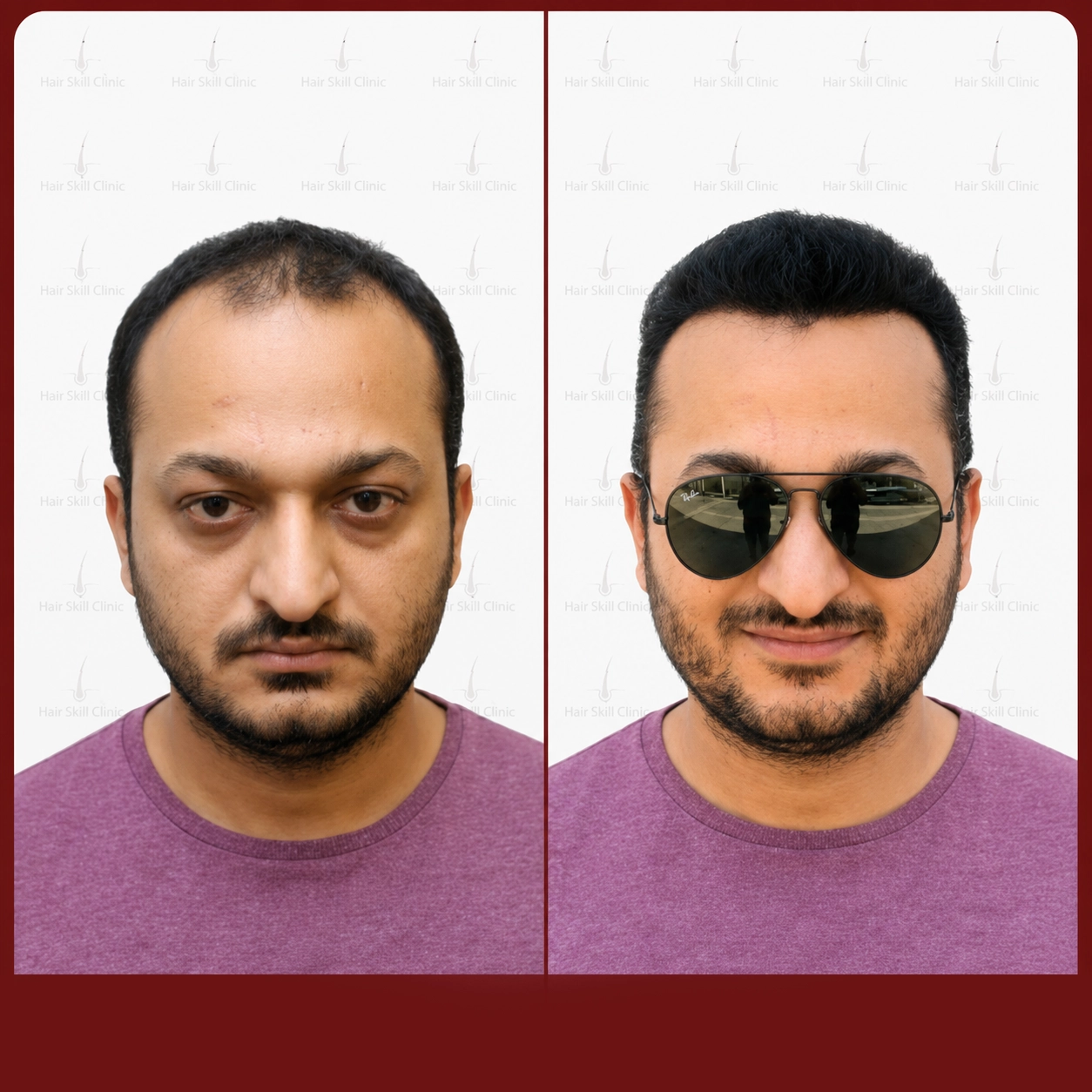 Grafts Transformation