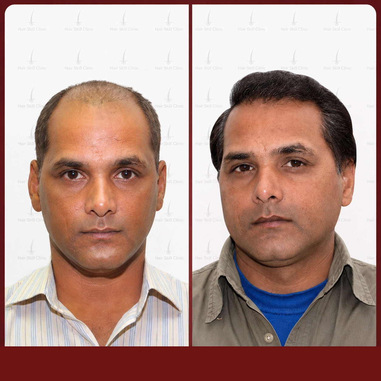 Grafts Transformation