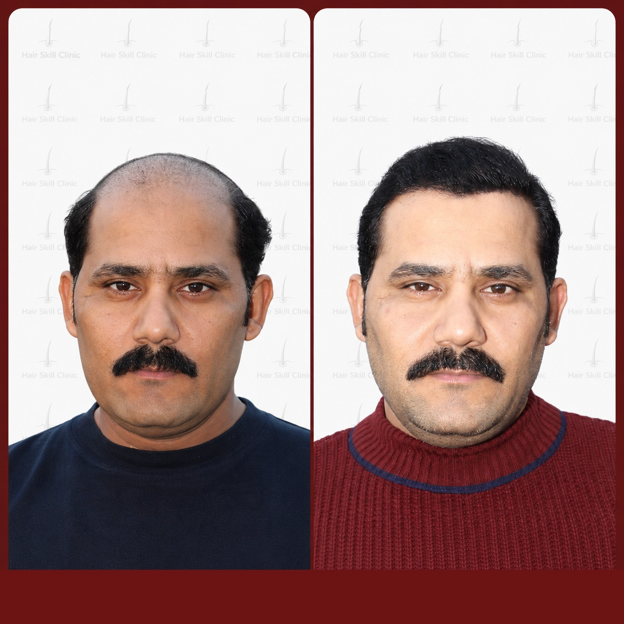 Grafts Transformation