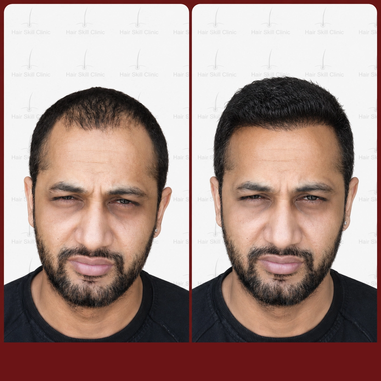 Grafts Transformation