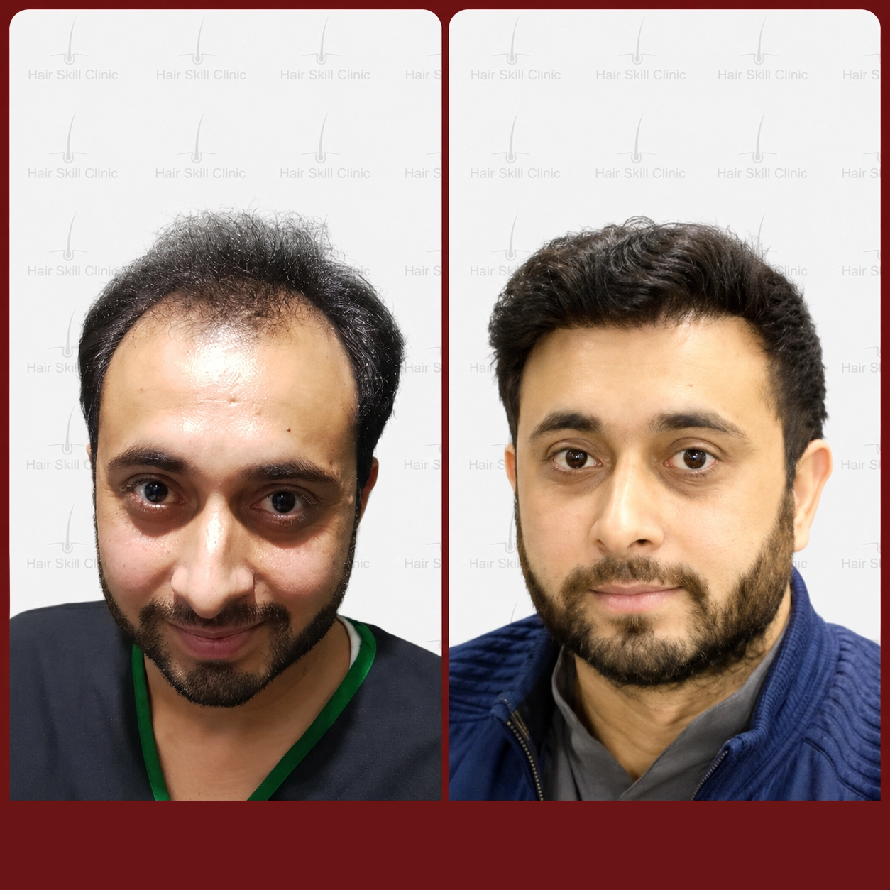 Grafts Transformation