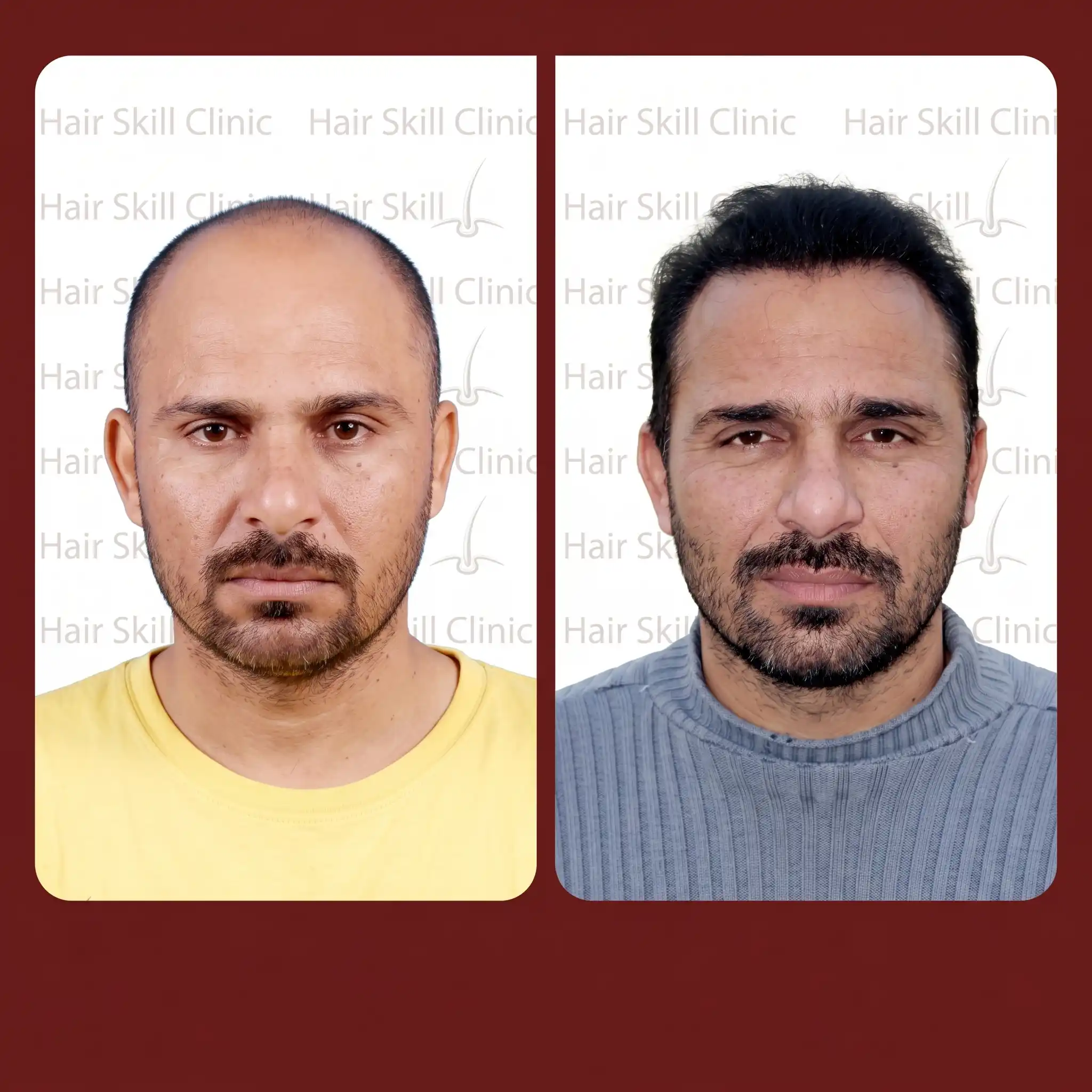 Grafts Transformation