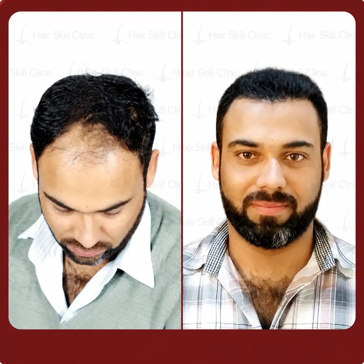 Grafts Transformation