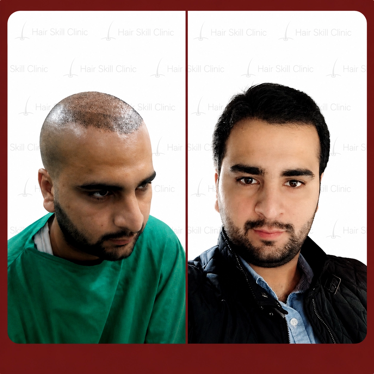 Grafts Transformation