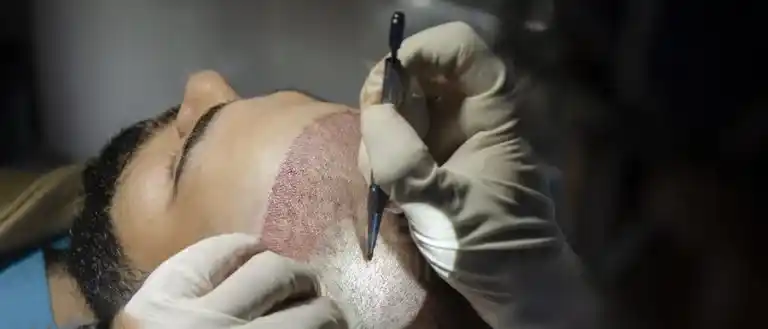 Manual Fue Hair Transplant