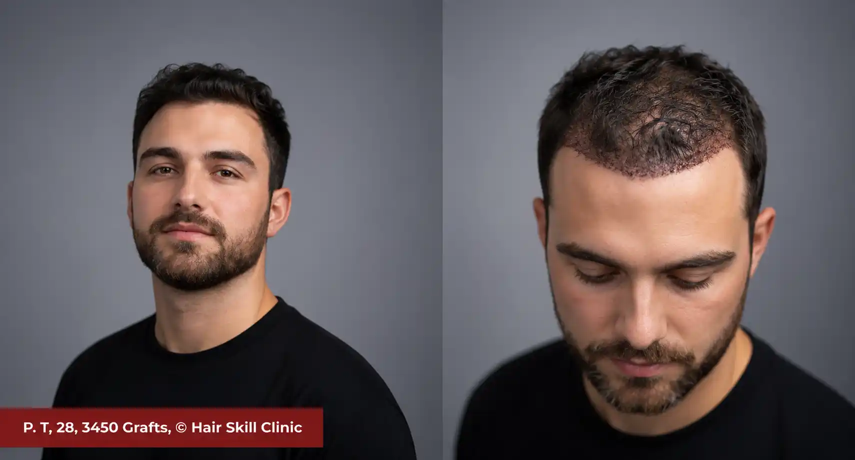 Split comparison of patient in orange shirt showing native forward styling versus un-shaved top recipient bed